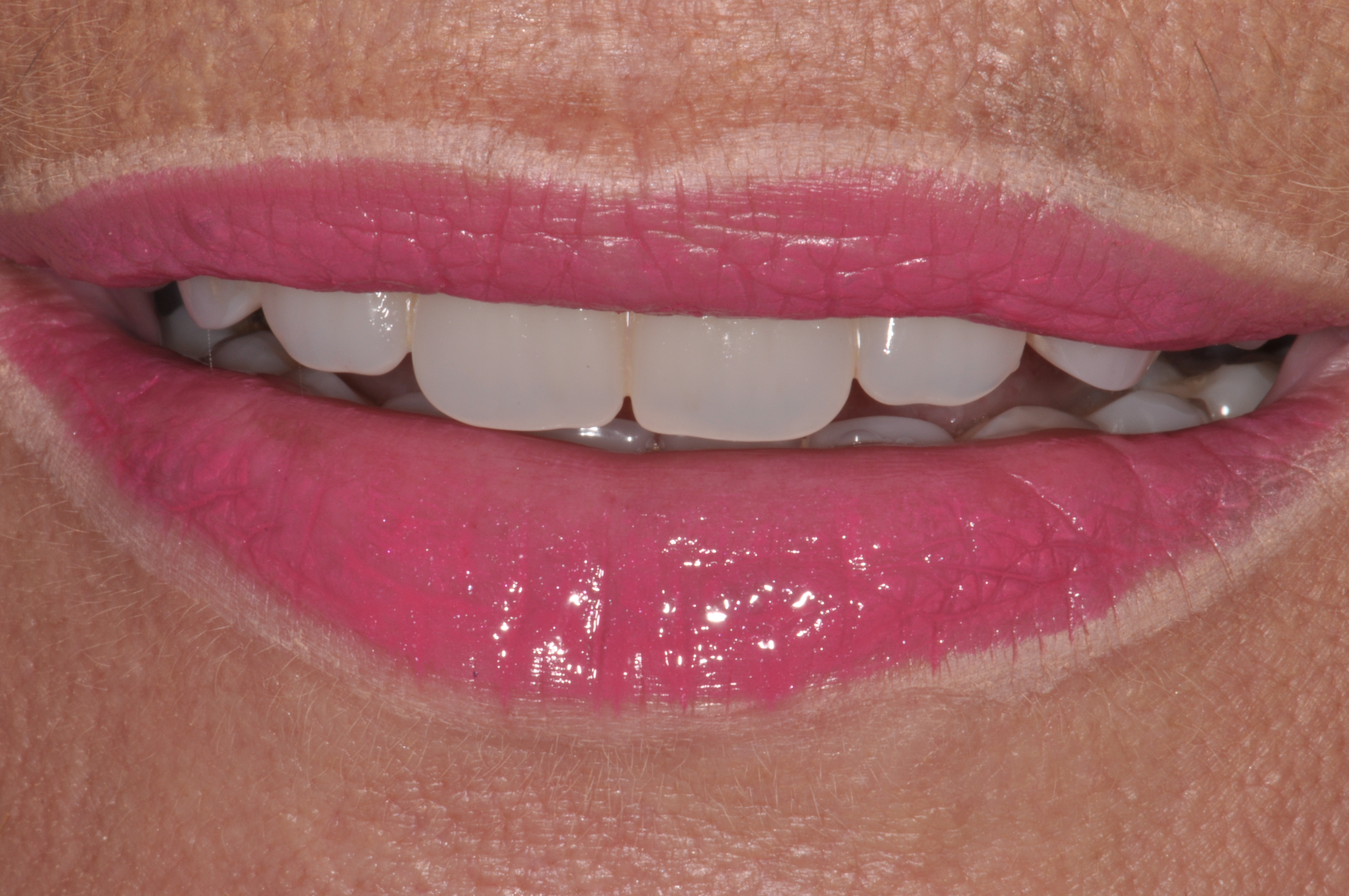 Festsitzender Ersatz auf Implantaten